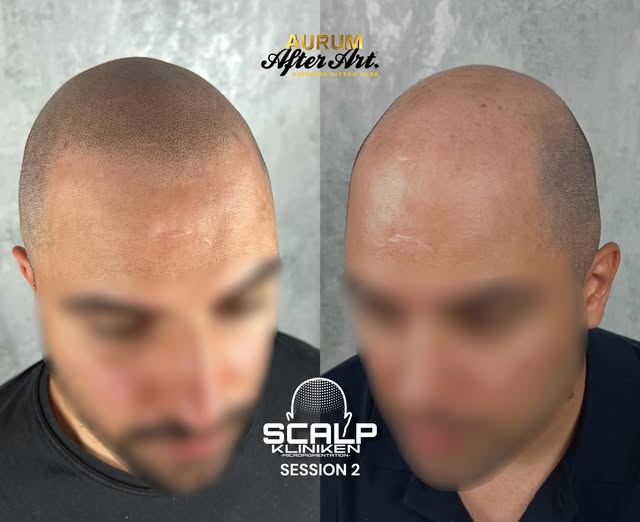 SESSION 2 RESULTS💨

Before & After.

ꜱᴄᴀʟᴘᴋʟɪɴɪᴋᴇɴ ꜱᴡᴇᴅᴇɴ

♠️𝑨𝑭𝑻𝑬𝑹𝑨𝑹𝑻 𝑺𝑷𝑶𝑵𝑺𝑶𝑹𝑬𝑫 𝑨