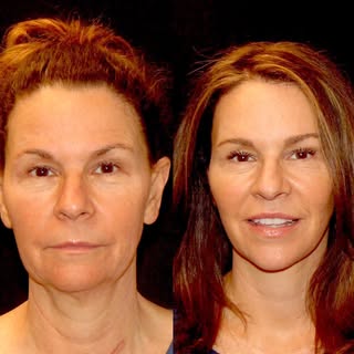 Our beautiful patient 8 months after her La Jolla Lift👏🏼 She is loving her new found confidence an
