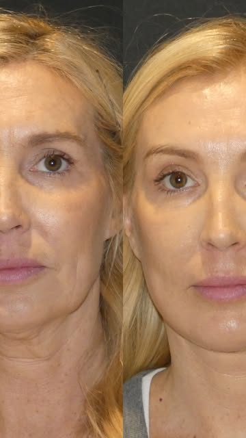 ✨ 4 months post-op and glowing! ✨ Our beautiful patient is radiating confidence after her deep plane