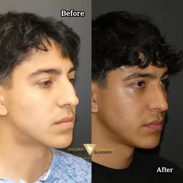 ✨ Dramatic before & after rhinoplasty ✨

One year post-op, showing an amazing improvement in facial 