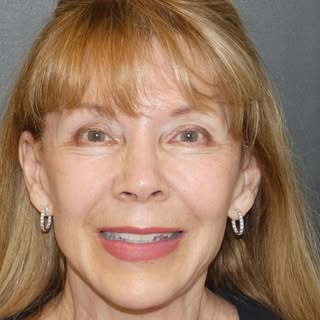 My beautiful patient is one year post op from her deep plane La Jolla Lift. I love how she looks nat