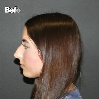 This wonderful patient of mine is  3 months postop and already looking great following her rhinoplas