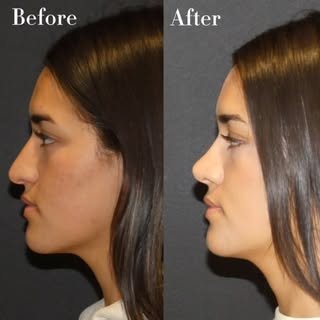 One year after rhinoplasty and her transformation continues to look beautiful. A natural, balanced r