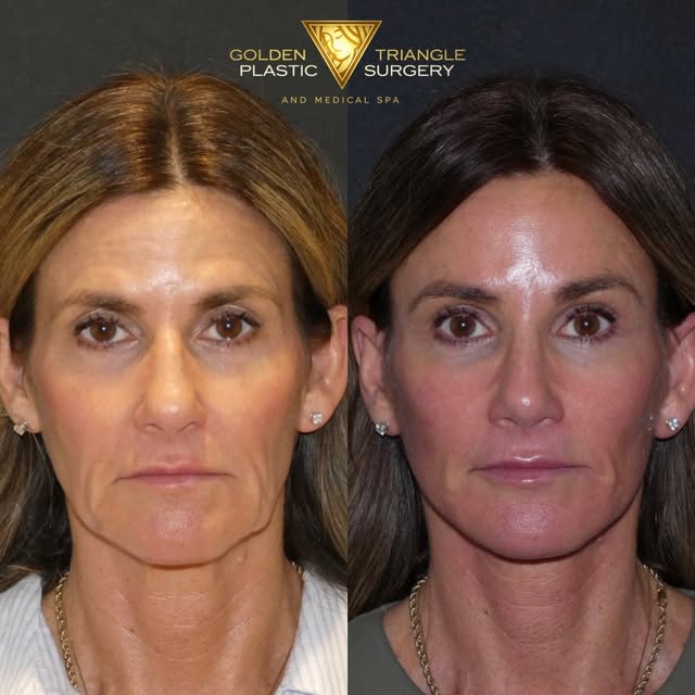 Just under 2 months post op from a deep plane facelift and rhinoplasty . Not many surgeons can combi