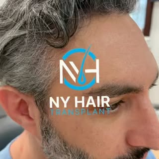 7 months post-transplant, and the progress is already making a difference.

Hair restoration isn’t j