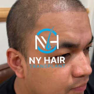 A new hairline, and a new sense of confidence.

Just two weeks after his hair transplant, the transp