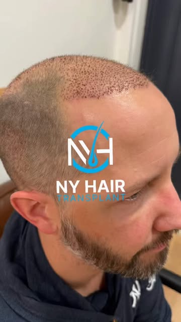 Hair restoration doesn’t end when the procedure is finished.

At NY Hair Transplant, we focus on eve