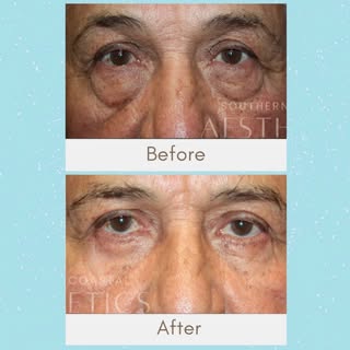 ✨ Brighten and refresh your eyes with Bilateral Lower Lid Blepharoplasty! Say goodbye to under-eye b