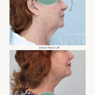 Fresh start, refined results. ✨ This transformation was achieved with a direct neck lift performed b