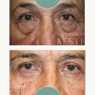 Brighter eyes, smoother under-lids. Bilateral Lower Lid Blepharoplasty designed to reduce puffiness 