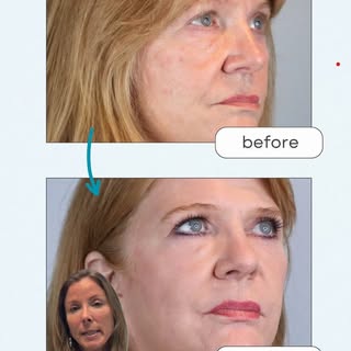 ✨ A closer look at what's possible. CO₂ laser resurfacing can help improve skin texture, soften fine