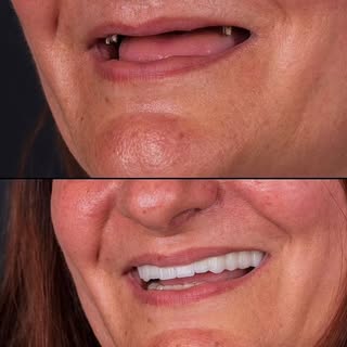 START SMILE TODAY 

8 Implant All on Four System 24 Porcelain Crowns 

57 Age Holland Patient

Resea
