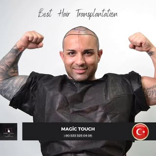Hurry for Hair Transplantation, Do Not Miss the Opportunity!

Don't waste your time Saying "Someday,