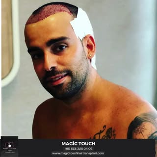 Que signifie être un candidat approprié pour une greffe de cheveux ?

La perte de cheveux chez les h