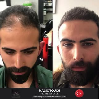 ما هي المدة التي تستغرقها عملية زراعة الشعر وهل هي مؤلمة؟
لا، بما أن العملية تتم تحت التخدير الموضعي