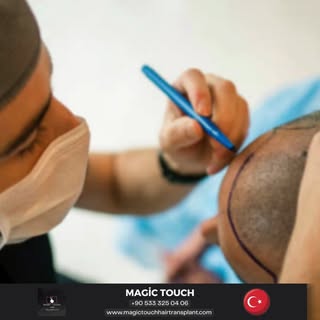 Ist Türkiye ein geeigneter Ort für eine Haartransplantation?

Türkiye ist zweifellos führend in der 