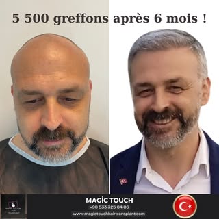 La greffe de cheveux n'est pas qu'une opération.

C'est une expérience qui change la vie.

N'attende