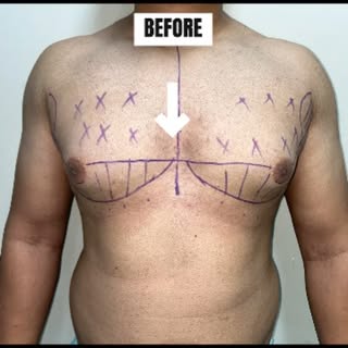 Grade 2 Gynecomastia: Before & After!

A powerful transformation! No more discomfort, no more second