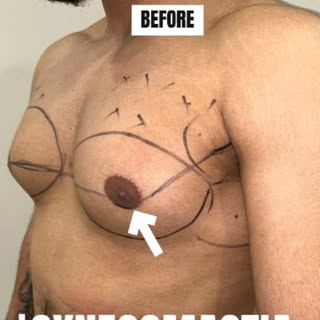 Grade 3 Gynecomastia Transformation! ✨

Before & after—what a difference! 💪 Gynecomastia can be tou