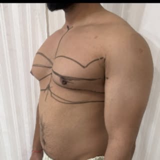 This patient had severe gynecomastia with prominent chest tissue and upward-pointing nipples — a con