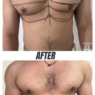 This professional athlete and bodybuilder was dealing with Grade 3 gynecomastia — a struggle that af