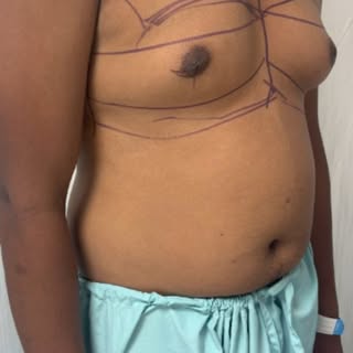 This young man had been silently battling gynecomastia for over a decade. 

He was deeply conscious 