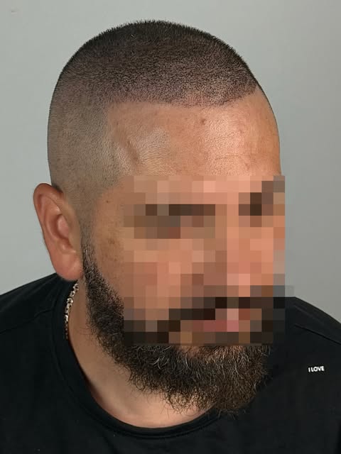 2 Hair Transplants. Still Thin. Then Came SMP. 🔥

After undergoing two hair transplants, my client 