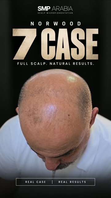 NORWOOD 7. 

A full transformation begins. 🔥

Advanced hair loss requires the right planning, densi