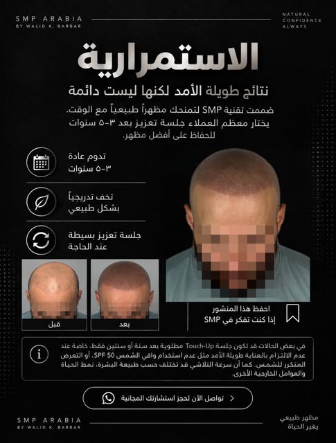 نتائج الـSMP طويلة الأمد… لكنها ليست دائمة. ⏳

مع مرور الوقت، يخفّ لون الصبغة تدريجياً بشكل طبيعي، و