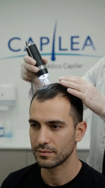 A los treinta y pocos la alopecia androgenética casi nunca se ve. Se supone.

El folículo empieza a 