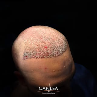 14 días post implante capilar ✨

A solo 14 días del procedimiento, podemos observar una evolución co