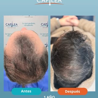 ✨ ¡ALTA MÉDICA CAPILEA!

Hoy damos por finalizada una nueva etapa en este proceso de transformación 