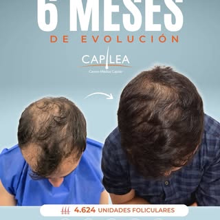 6 MESES DE EVOLUCIÓN

A los 6 meses del implante capilar, ya podemos observar una evolución signific
