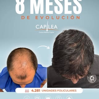 8 MESES DE EVOLUCIÓN 

Ya nos acercamos al 75% de la evolución esperada de este implante capilar.

A