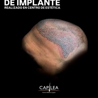 Una reparación capilar requiere algo más que volver a implantar folículos. Requiere planificación, e