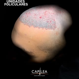 5.153 UNIDADES FOLICULARES
La clave de todo implante capilar está en la zona donante. 

Cuando conta