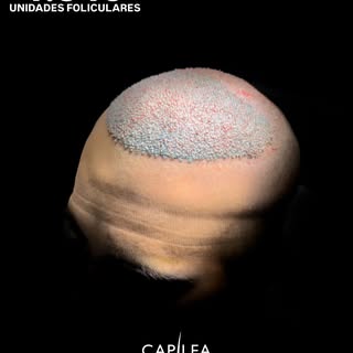 4.540 unidades foliculares para desarrollar la primera mitad de un caso avanzado de alopecia.

En ca