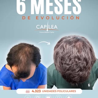 6 MESES DE EVOLUCIÓN

A los 6 meses del implante capilar, ya podemos observar una evolución signific