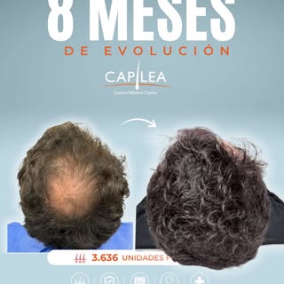 8 MESES DE EVOLUCIÓN 

Esta coronilla ya está casi resuelta. Estamos llegando aproximadamente al 70%