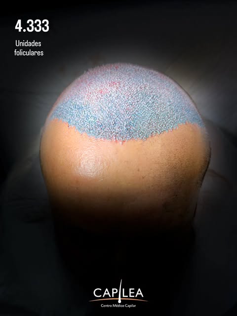 4.333 unidades foliculares implantadas mediante técnica FUE.

Un procedimiento planificado de forma 