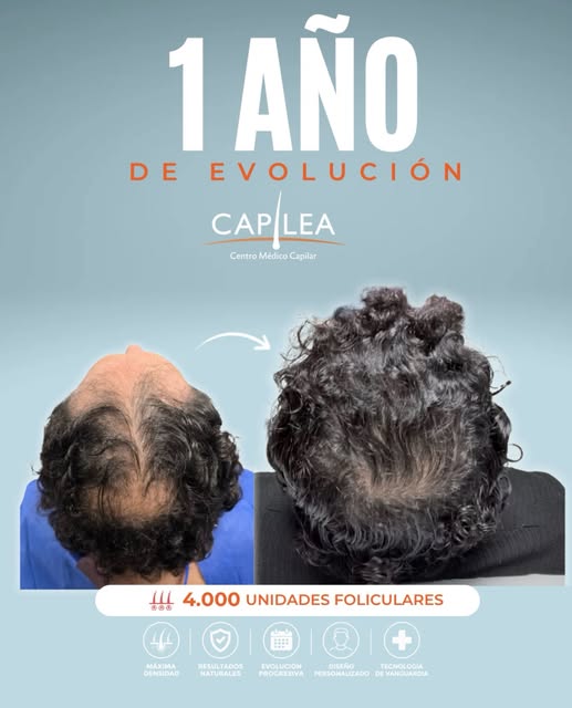 Un año después de su implante capilar 

En este caso se implantaron 4.000 unidades foliculares, prio