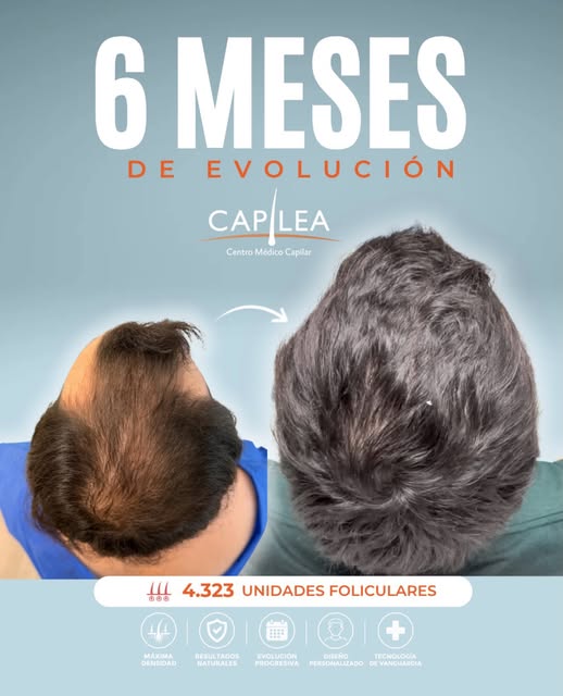 6 MESES DE EVOLUCIÓN

A los 6 meses del implante capilar, ya podemos observar una evolución signific
