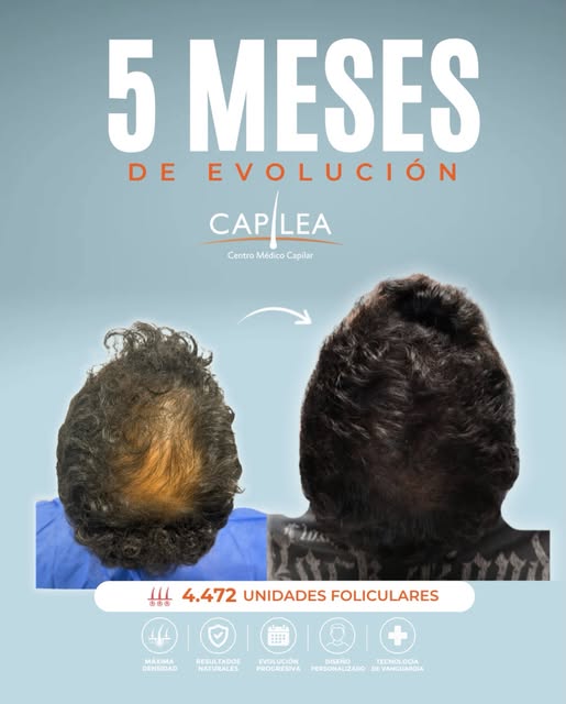 5 MESES DE EVOLUCIÓN | IMPLANTE CAPILAR

A 5 meses de su implante capilar, podemos observar un avanc