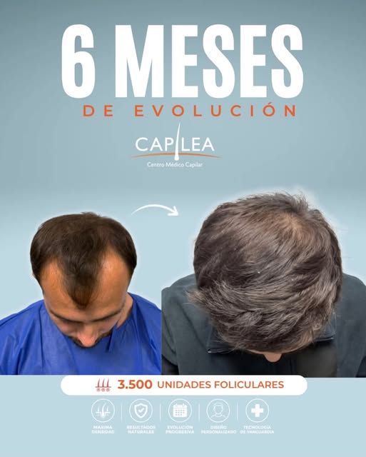 ✨ ¡Qué espectacular transformación después de solo 6 meses de implante capilar en la zona frontal!


