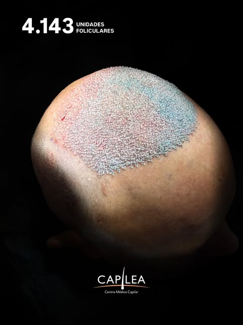 4.143 unidades foliculares para realizar la reconstrucción fase 1 de una alopecia grado VII, avanzad