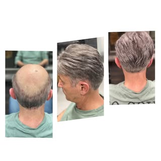 🤩 netjes weer #alopeciaandrogenetica #haaruitvalbijmannen #ankohaarwerkspecialist #uwhaarspecialist