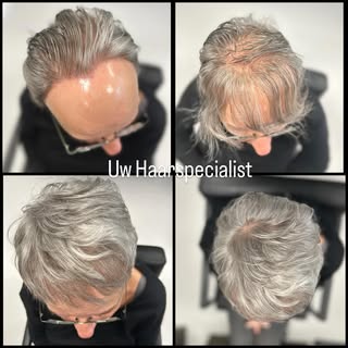 Weer een cliënt met FFA : Frontale Fibroserende Alopecia haar oude vertrouwde look weer terug gegeve