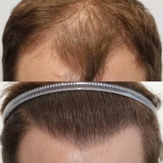 Bei der Haartransplantation legen wir besonderen Wert darauf, eine natürliche Haarlinie zu erzielen.