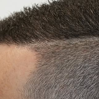 Wir ermöglichen unseren Kunden wieder volles Haar.👨‍🦰