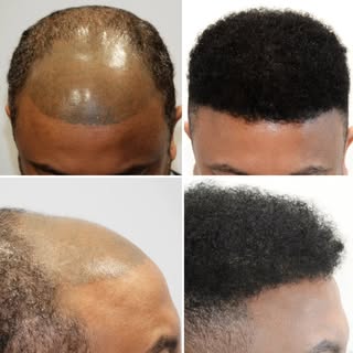 Wir verwenden die schonendsten Methoden der Haartransplantation auch bei Afro-Haaren. 😍
#haartransp